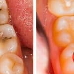 Composite Fillings - Tooth-Colored Fillings