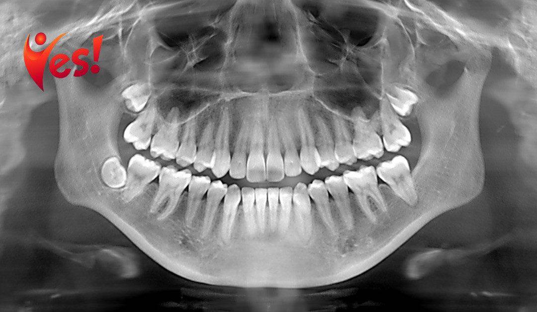 Dental X-Rays Explained