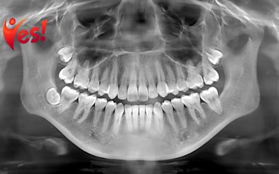 Dental X-Rays Explained