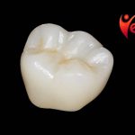 What Is a Zirconia Crown